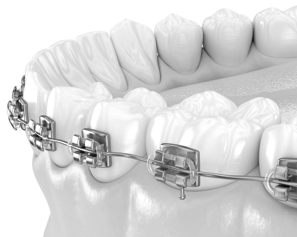 Traditional metal braces to straighten teeth.