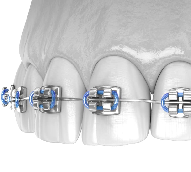 When someone chooses coloured braces, the coloured elastics bands can be switched out and customized however the patient chooses.
