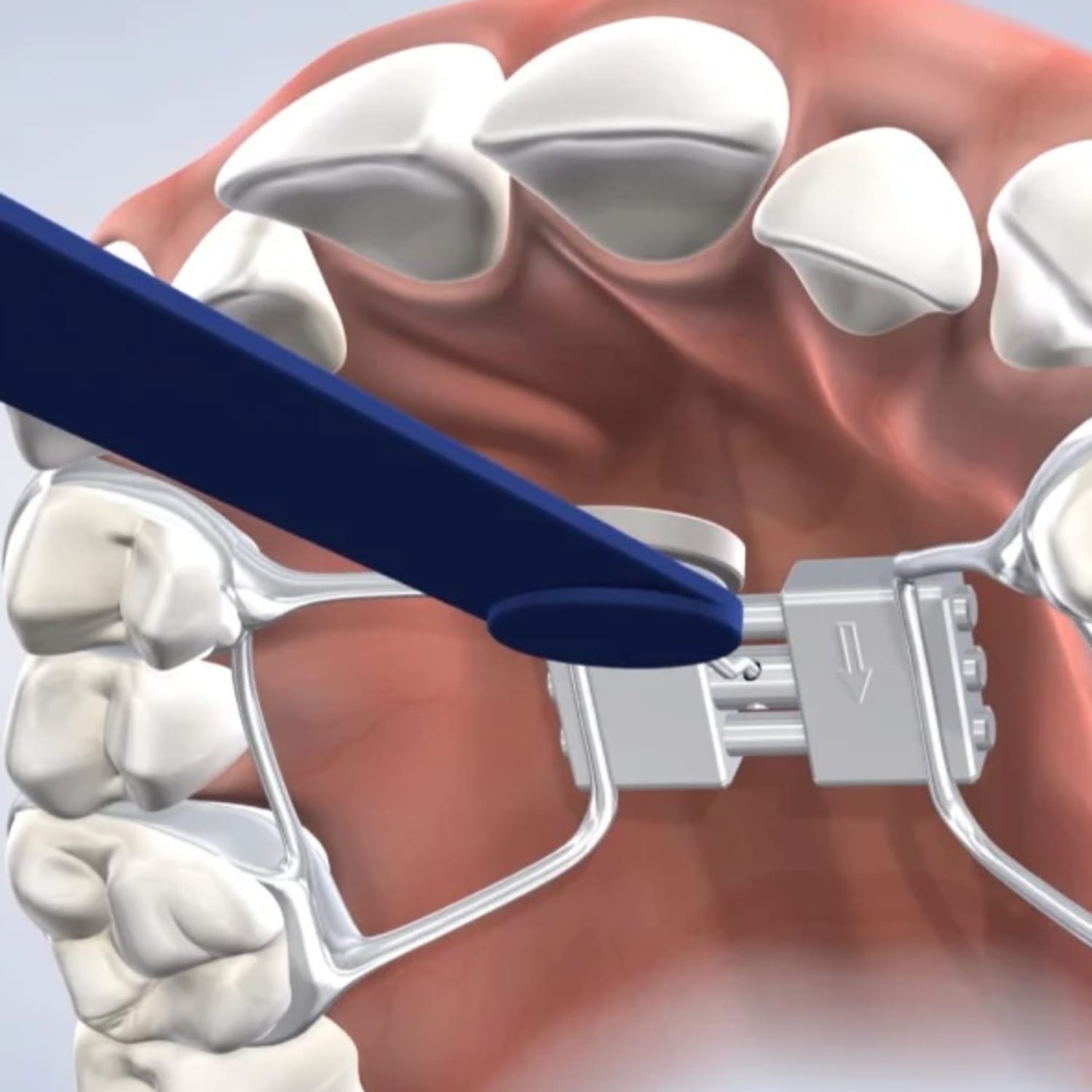 A young patient is sitting in an exam chair, smiling at the Nalchajian Orthodontics team member that is sitting beside him.