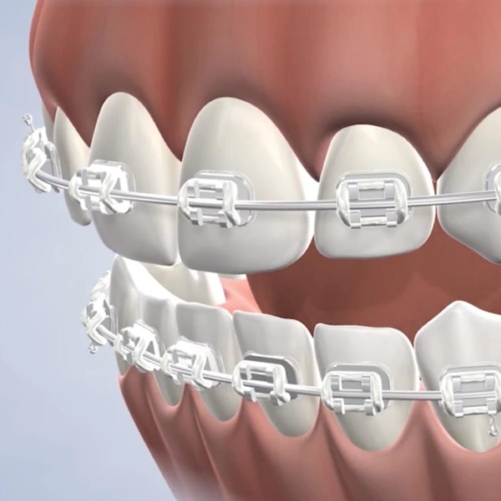 Patients are being treated in a row at Nalchajian Orthodontics.