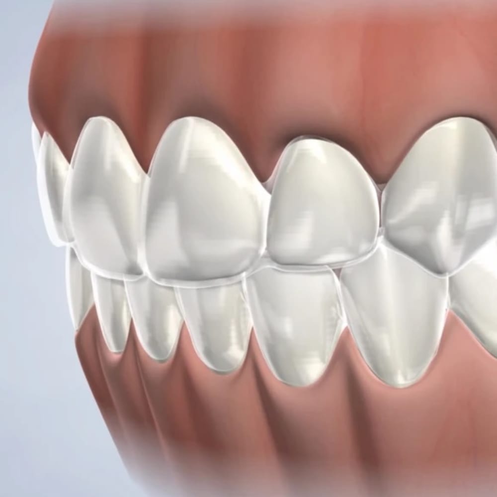 Invisalign Clear Aligners in Fresno and Clovis
